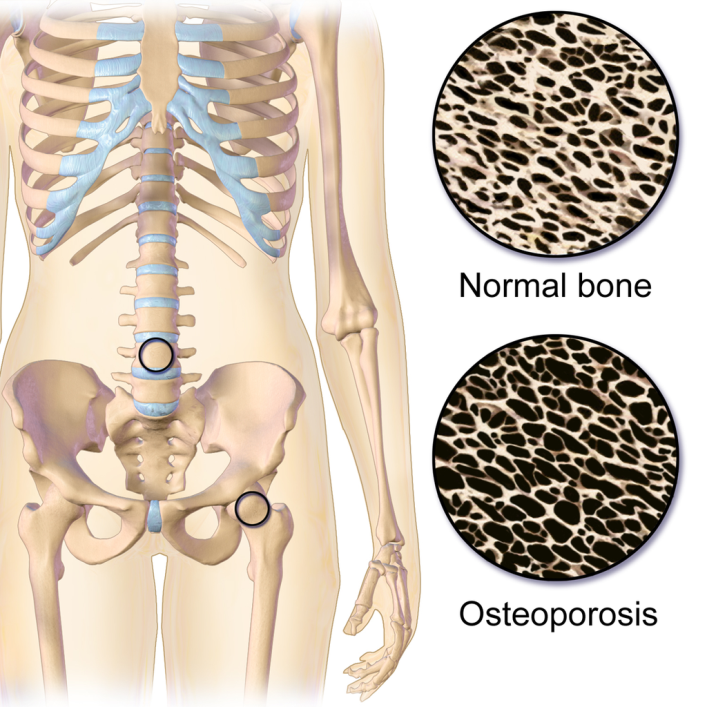 rysunek szkieletu, obok dwie grafiki: jedna przedstawia strukturę zdrowej kości, a druga strukturę kości z osteoporozą